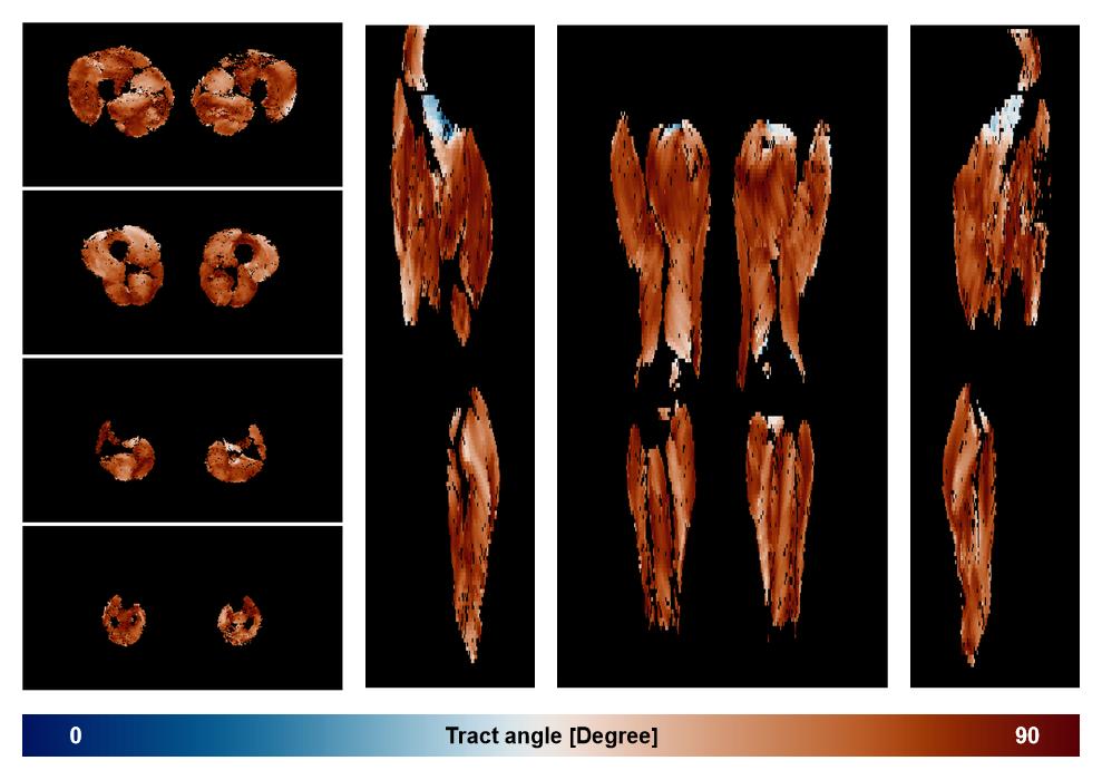 Muscle fiber tract angle map based on whole leg DTI based fiber tractography.