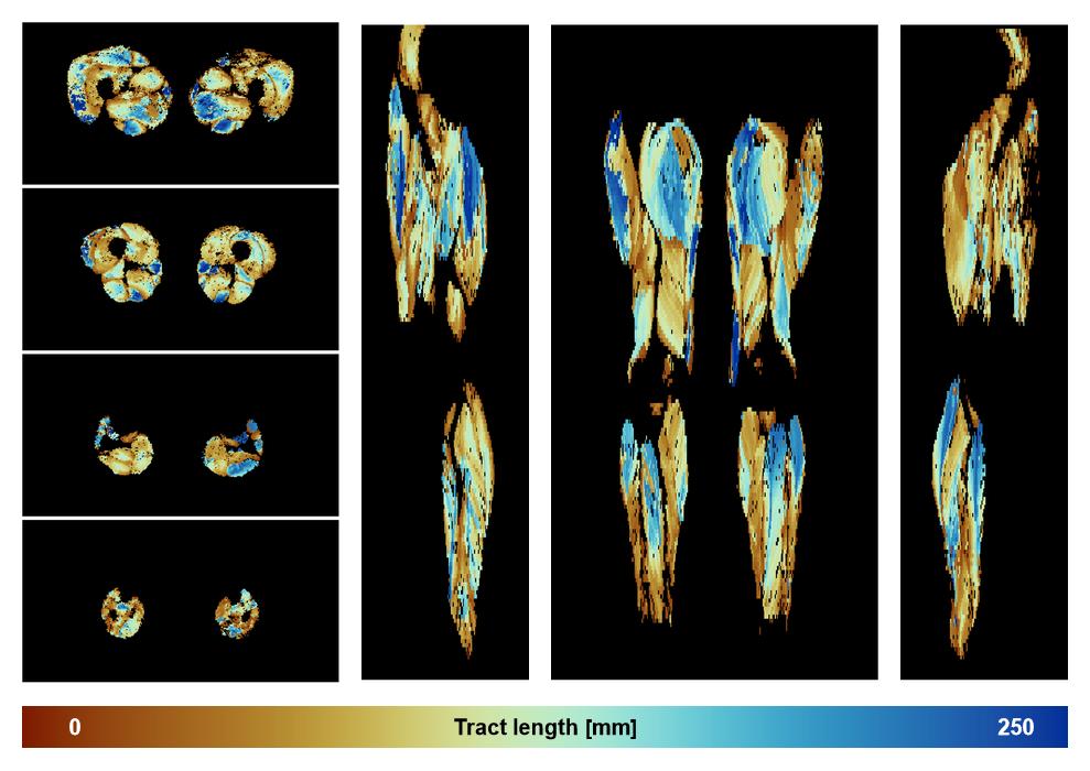 Muscle fiber tract length map based on whole leg DTI based fiber tractography.