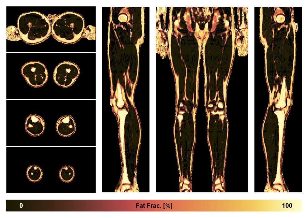 The fat fraction of the lower extremity obtained from the dixon reconstruction for muscle water fat quantification.