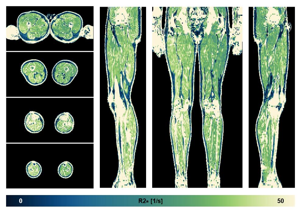 The R2 star relaxation time of the lower extremity obtained from the dixon reconstruction for muscle water fat quantification.