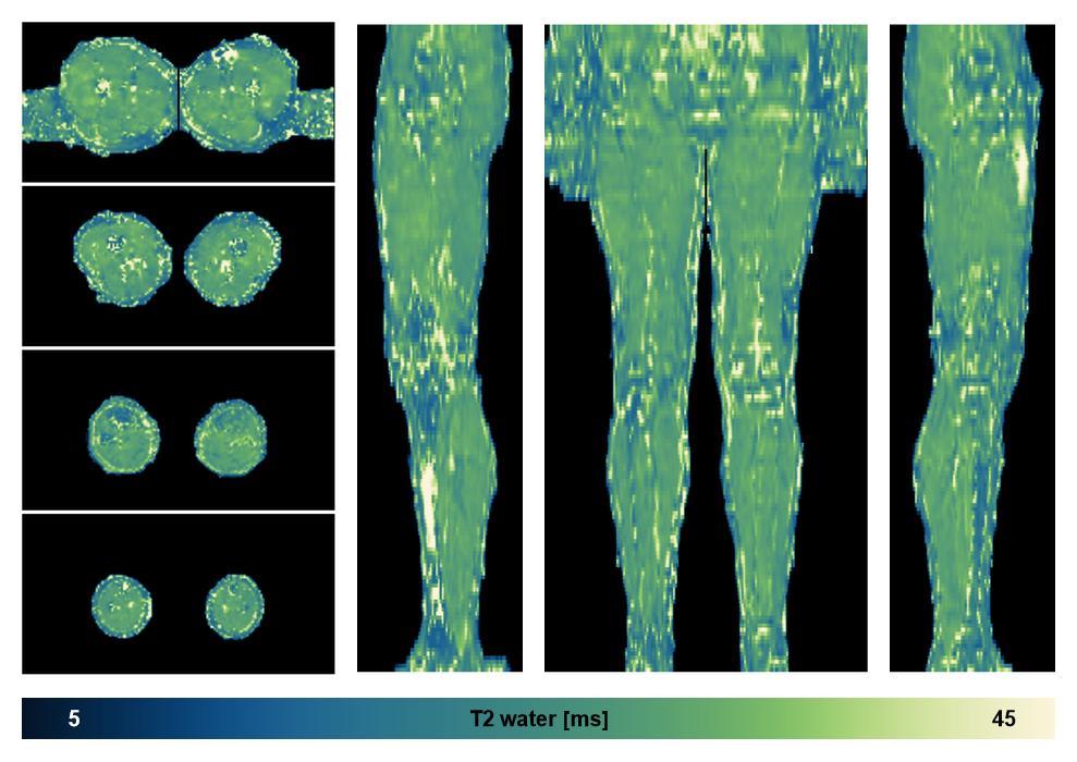The water only T2 relaxation time of the lower extremity obtained from multi echo spin echo t2 mapping with EPG based reconstruction.