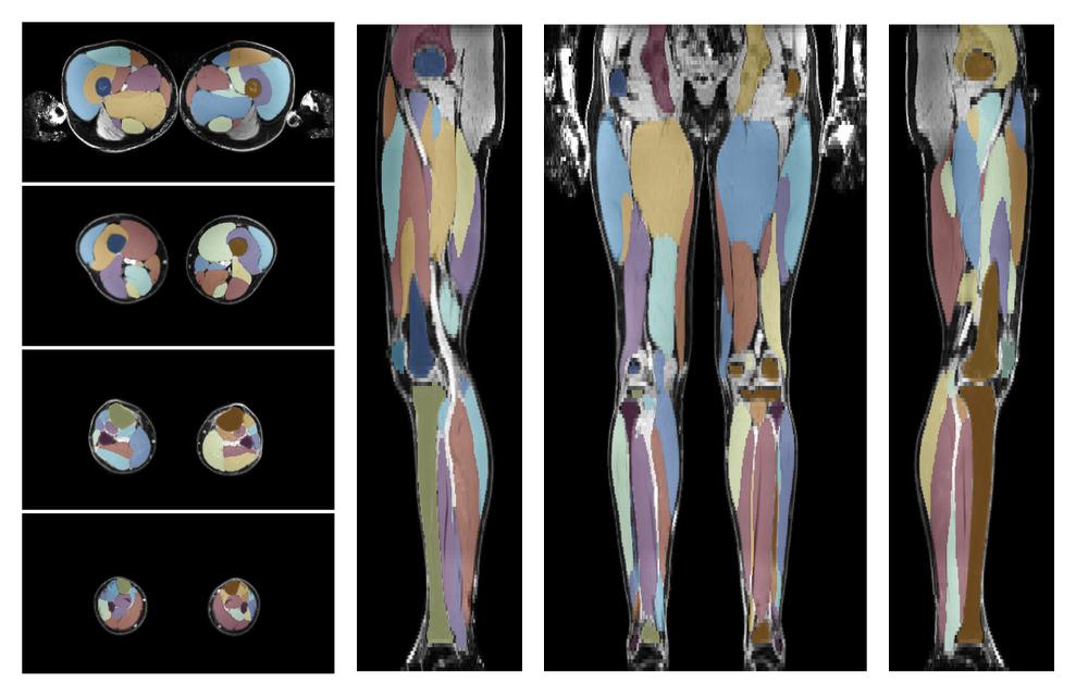 Overlay of automated muscle segmentation labels on dixon water image.