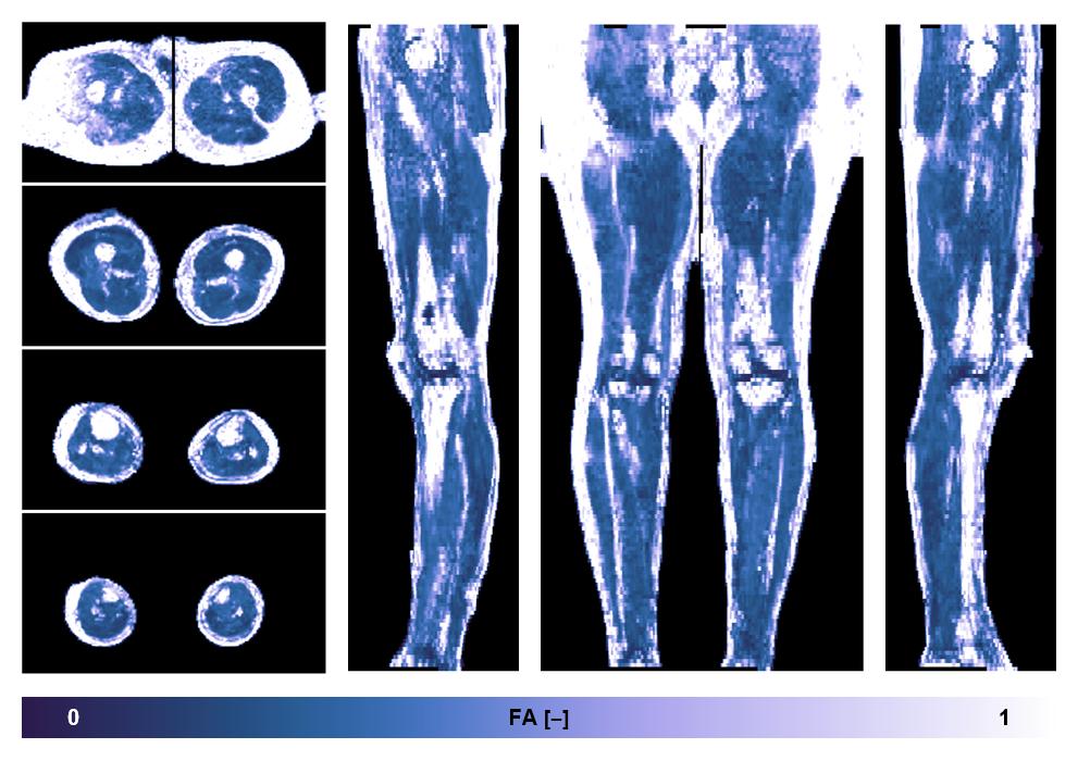 IVIM corrected whole leg muscle fractional anisotropy obtained from diffusion tensor imaging.