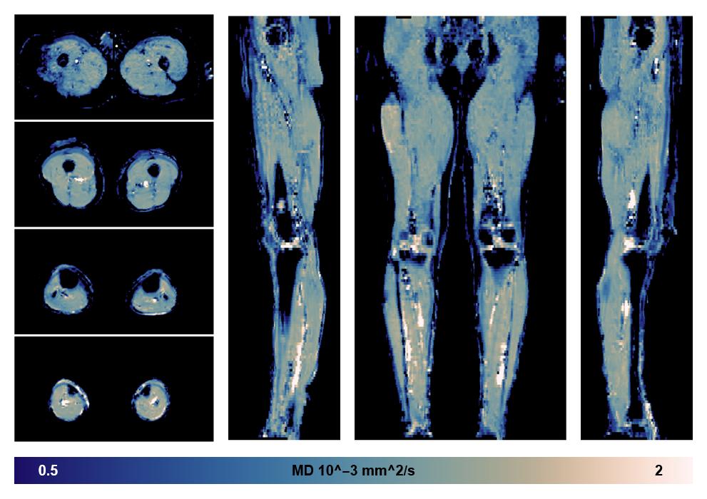 IVIM corrected whole leg muscle mean diffusivity obtained from diffusion tensor imaging.