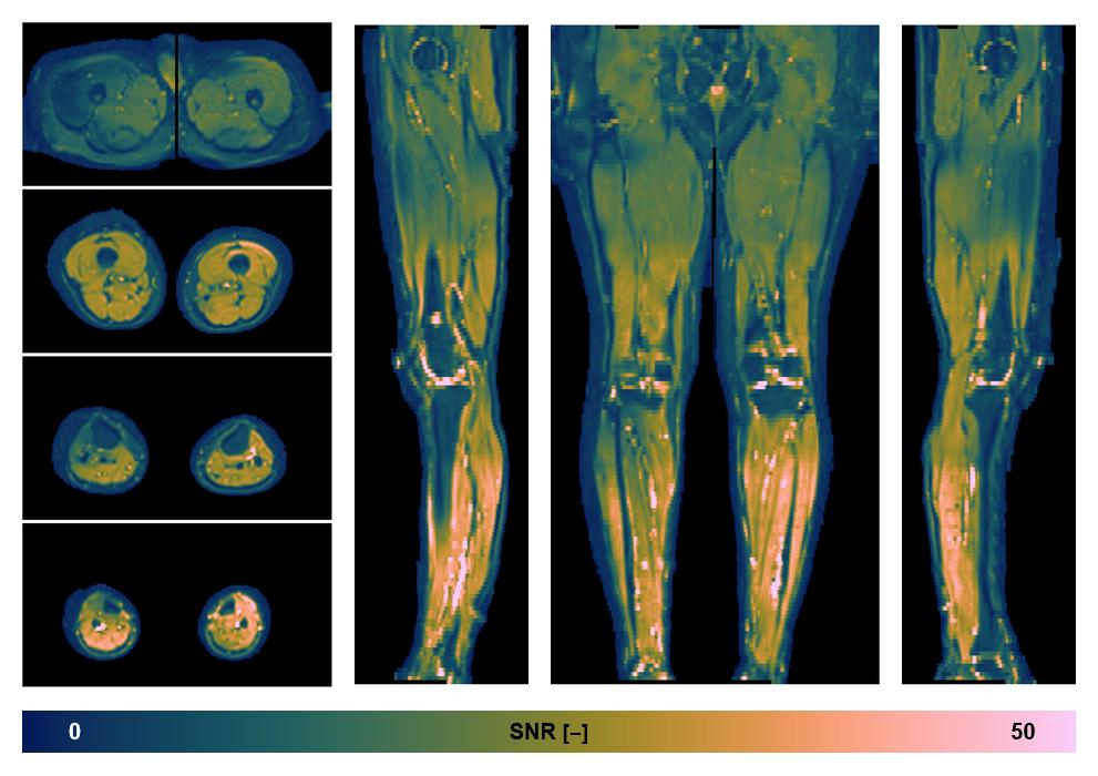 SNR distribution of the unweighted diffusion data.