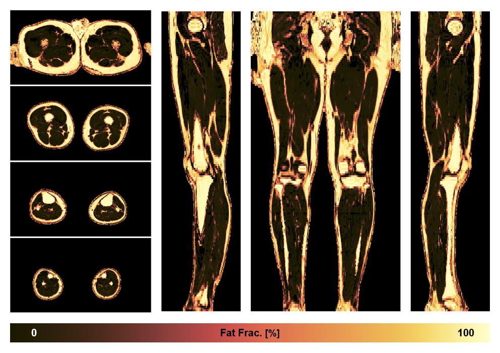 The fat fraction of the lower extremity obtained from the dixon reconstruction for muscle water fat quantification.