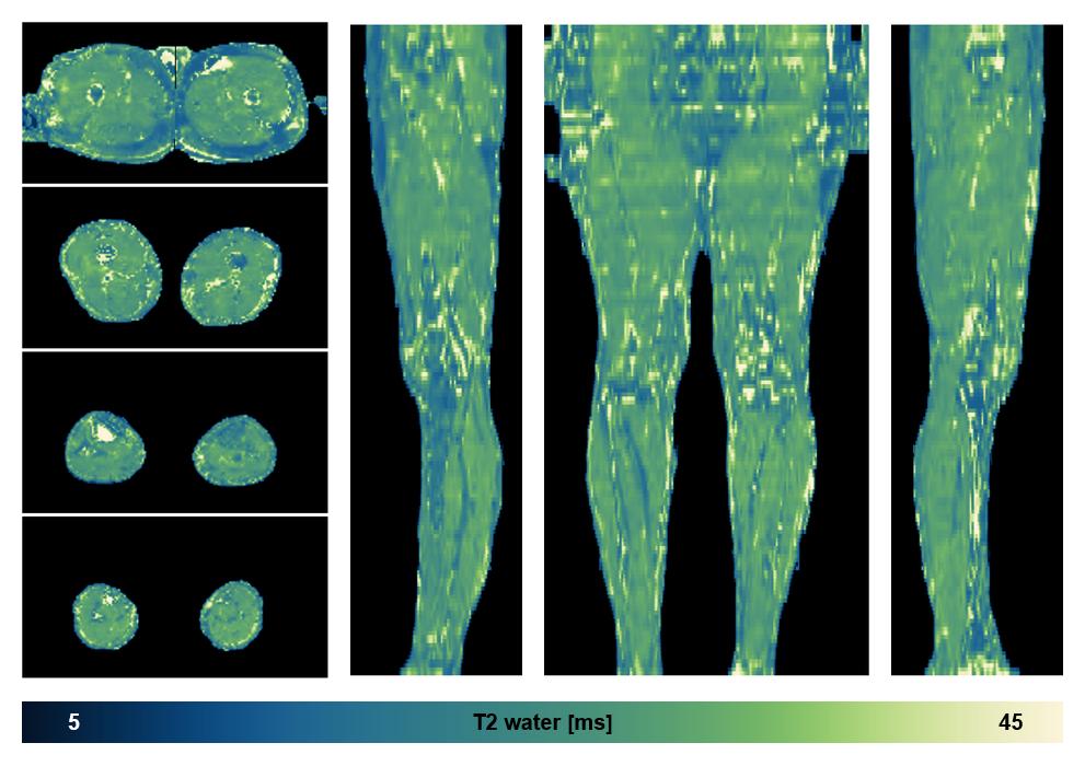 The water only T2 relaxation time of the lower extremity obtained from multi echo spin echo t2 mapping with EPG based reconstruction.