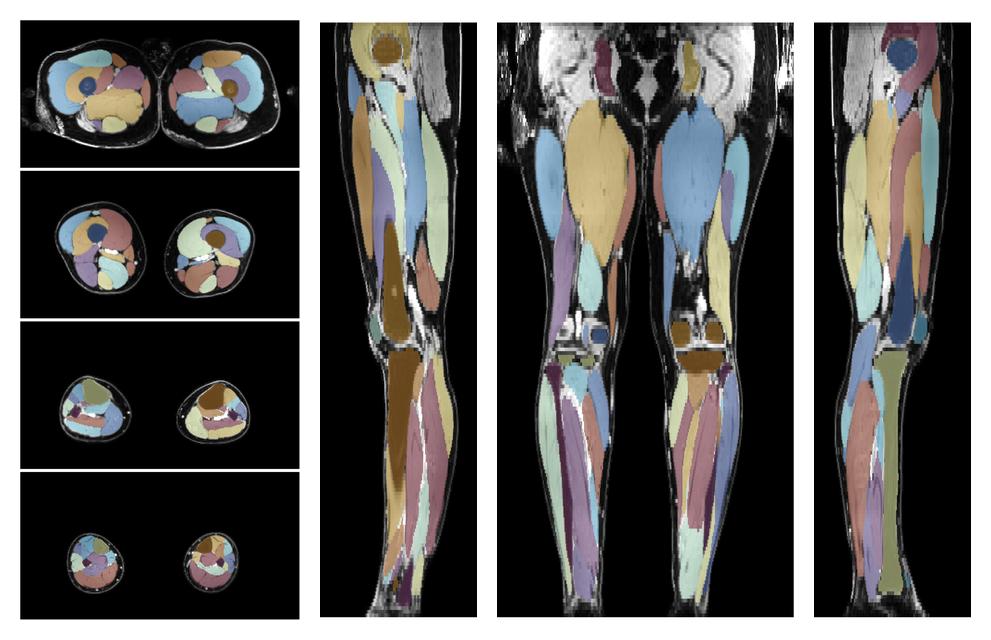 Overlay of automated muscle segmentation labels on dixon water image.