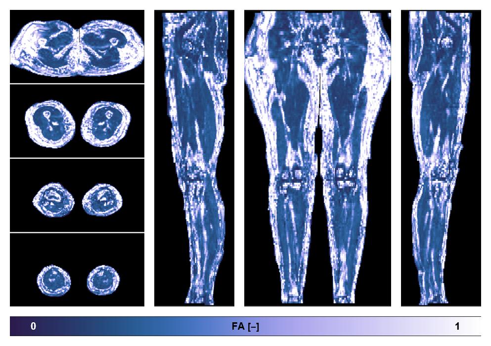 IVIM corrected whole leg muscle fractional anisotropy obtained from diffusion tensor imaging.