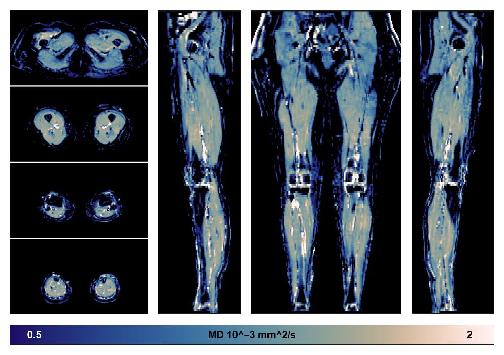 IVIM corrected whole leg muscle mean diffusivity obtained from diffusion tensor imaging.