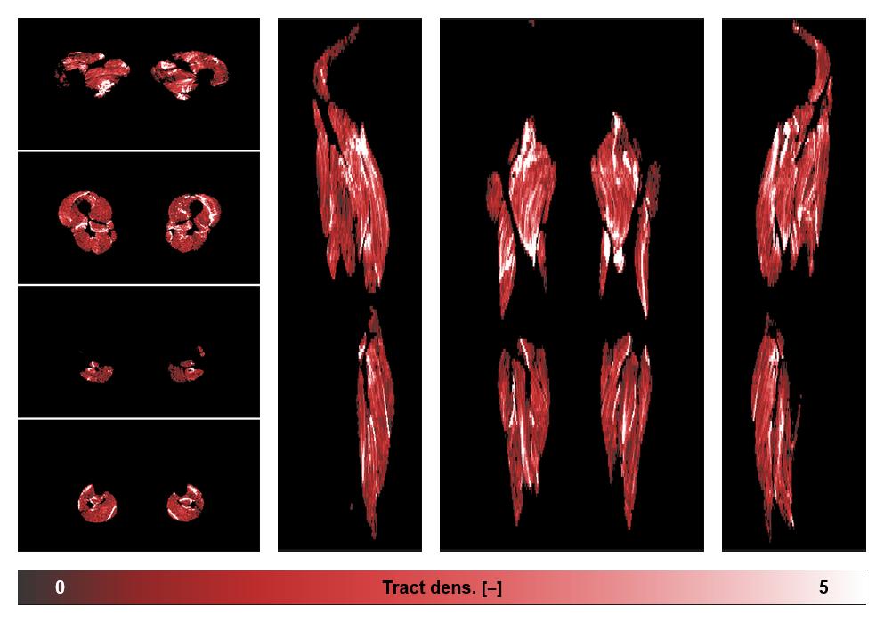 Muscle fiber tract density map based on whole leg DTI based fiber tractography.