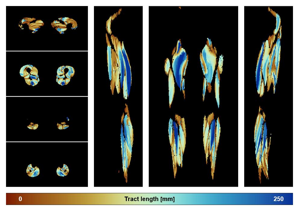 Muscle fiber tract length map based on whole leg DTI based fiber tractography.
