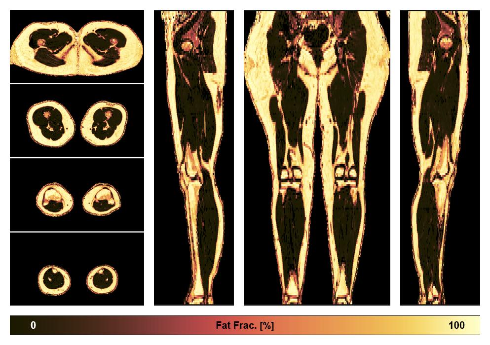 The fat fraction of the lower extremity obtained from the dixon reconstruction for muscle water fat quantification.