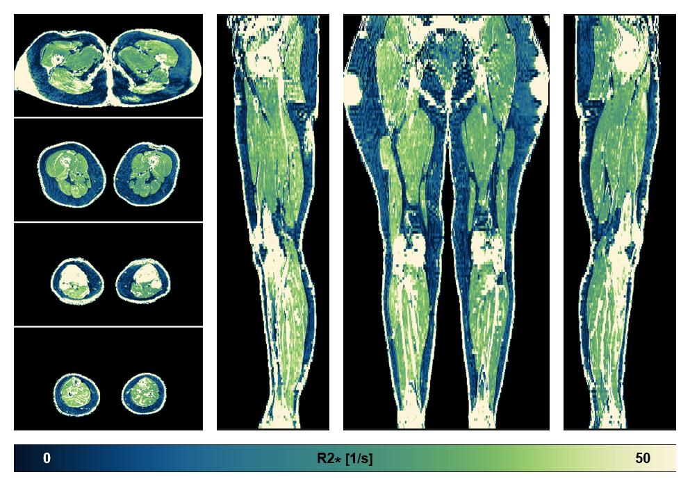 The R2 star relaxation time of the lower extremity obtained from the dixon reconstruction for muscle water fat quantification.