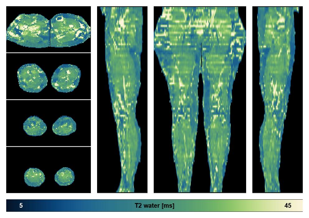 The water only T2 relaxation time of the lower extremity obtained from multi echo spin echo t2 mapping with EPG based reconstruction.