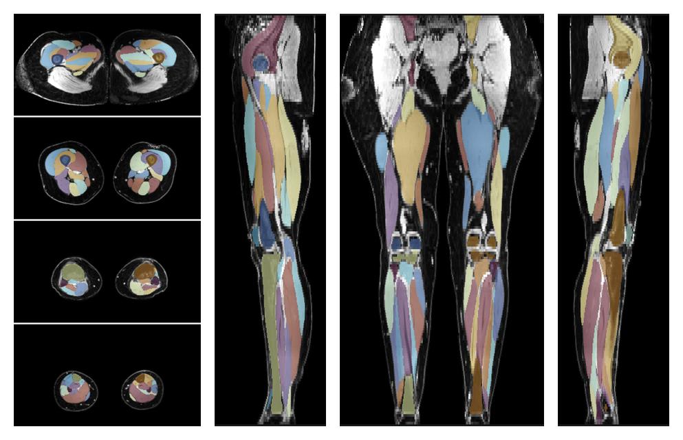 Overlay of automated muscle segmentation labels on dixon water image.