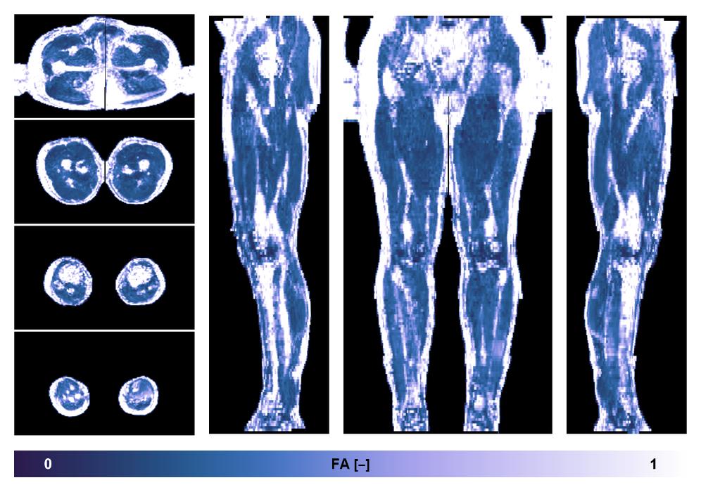 IVIM corrected whole leg muscle fractional anisotropy obtained from diffusion tensor imaging.