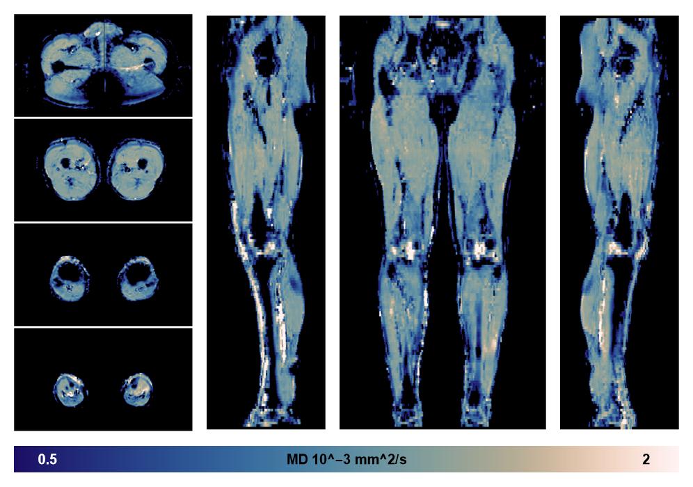 IVIM corrected whole leg muscle mean diffusivity obtained from diffusion tensor imaging.