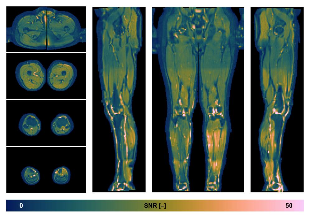 SNR distribution of the unweighted diffusion data.