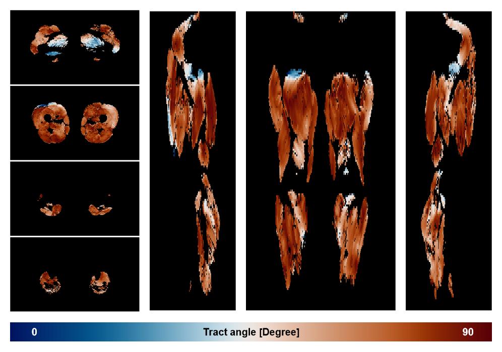 Muscle fiber tract angle map based on whole leg DTI based fiber tractography.