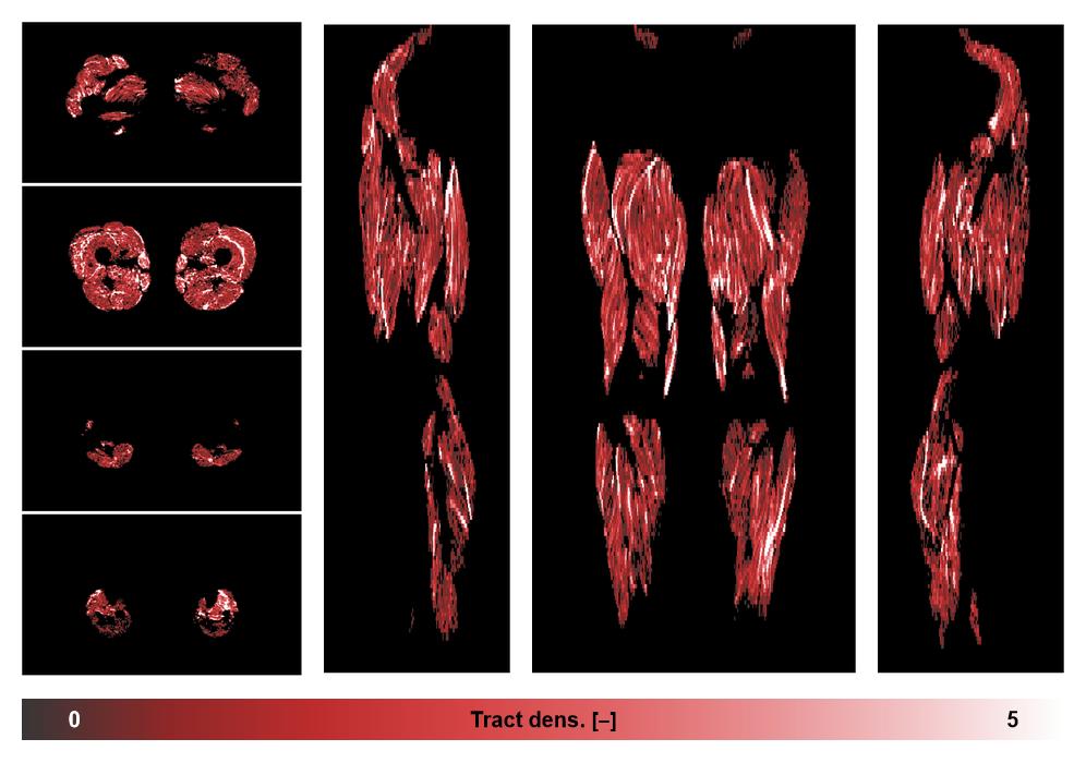 Muscle fiber tract density map based on whole leg DTI based fiber tractography.