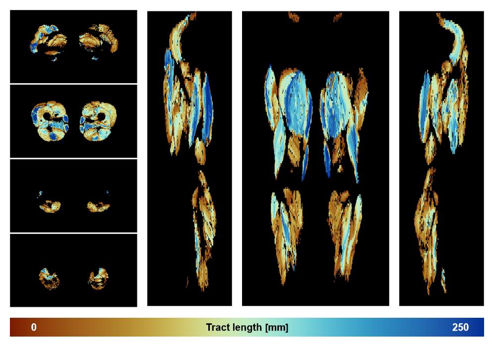 Muscle fiber tract length map based on whole leg DTI based fiber tractography.