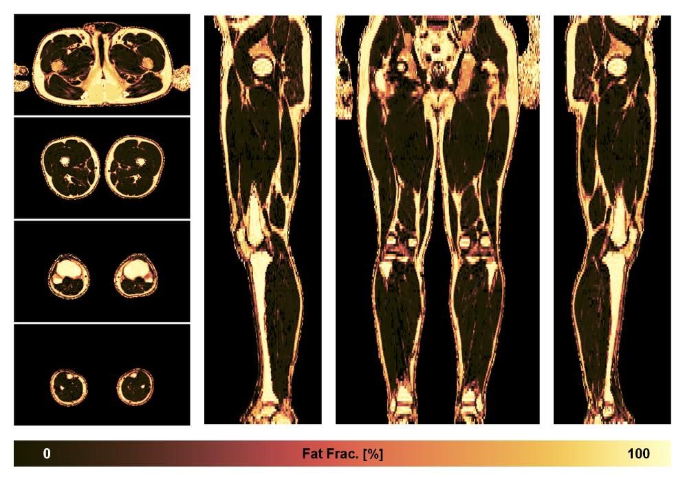 The fat fraction of the lower extremity obtained from the dixon reconstruction for muscle water fat quantification.