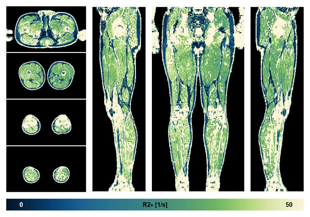 The R2 star relaxation time of the lower extremity obtained from the dixon reconstruction for muscle water fat quantification.
