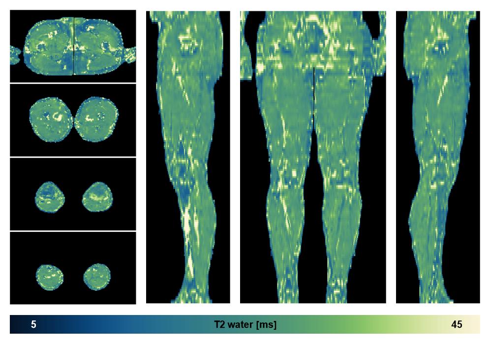 The water only T2 relaxation time of the lower extremity obtained from multi echo spin echo t2 mapping with EPG based reconstruction.