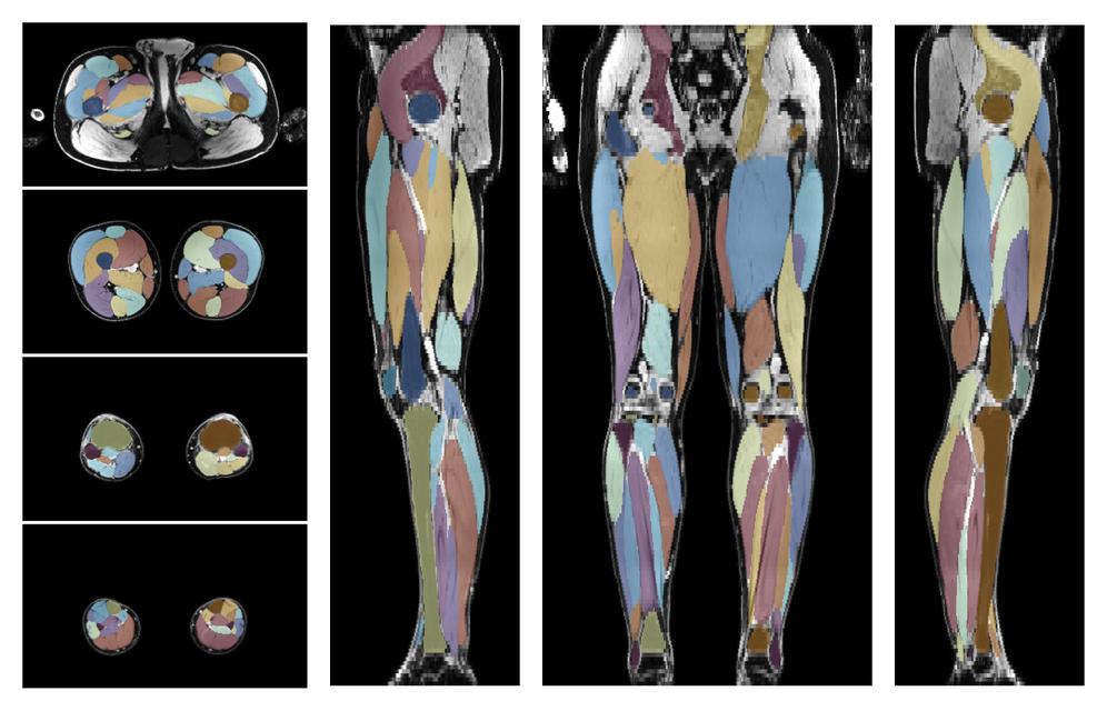 Overlay of automated muscle segmentation labels on dixon water image.