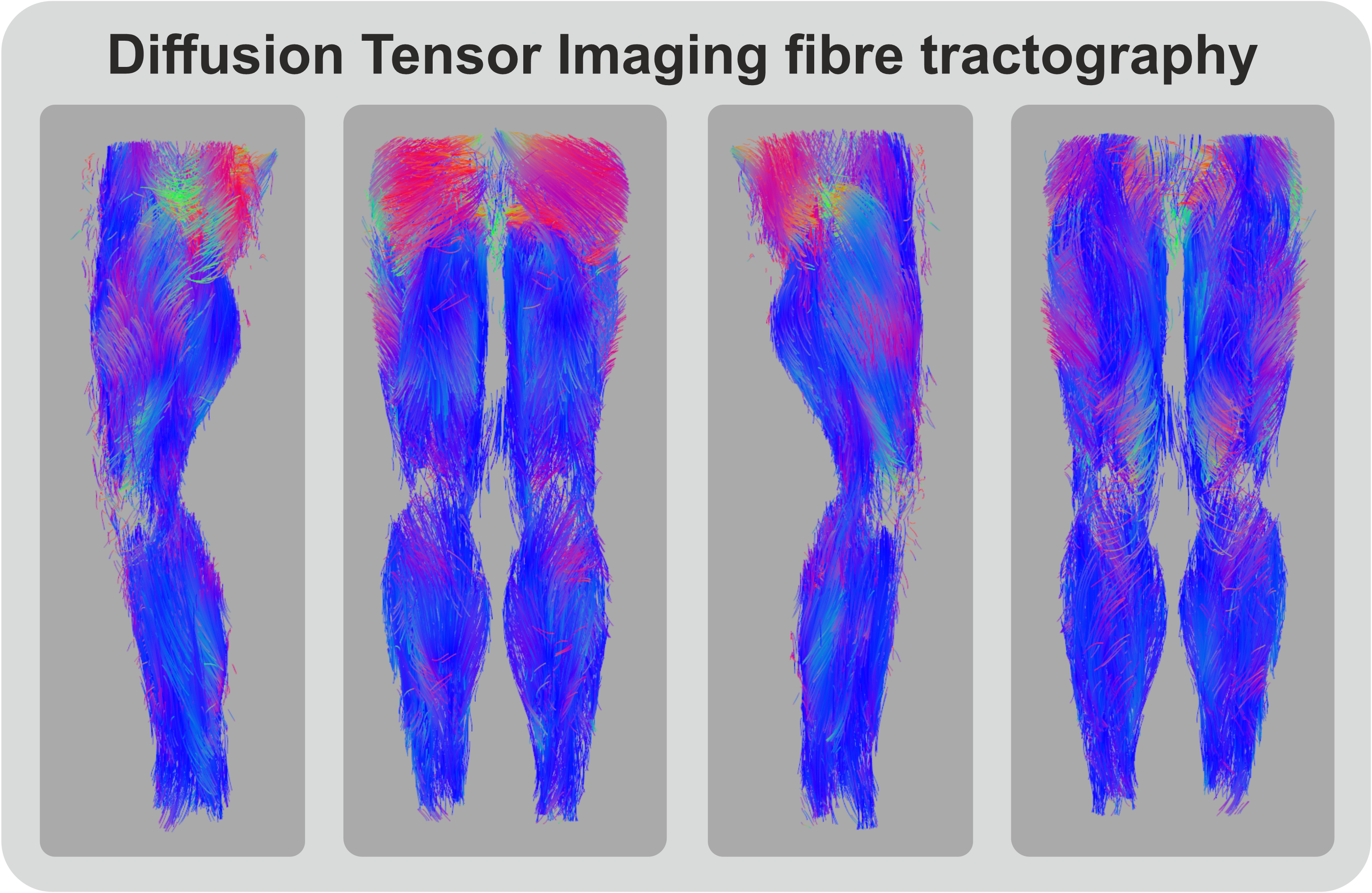 Whole leg Diffusion tensor imaging based muscle fiber tractography